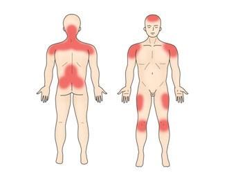 근근막통증증후군이 자주 생기는 부위. 서울아산병원 제공
