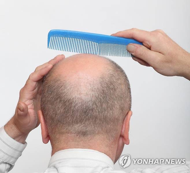 탈모 [게티이미지뱅크 제공]