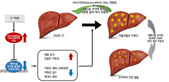 UNIST는 간 속의 'MIR20B' 유전물질이 지방 분해를 돕는 단백질의 발현을 억제한다는 사실을 밝혀냈다. 사진은 비알콜성 지방간 발병 기전과 MIR20B 억제제 투여 시 효과. UNIST 제공