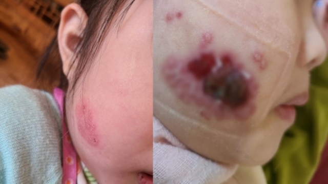 5세 딸의 뺨에 수포가 생겨 처음 병원에 갔을 당시 상태. 오른쪽 사진은 문제의 병원 방문 이후 상태가 악화한 모습. 온라인 커뮤니티 캡처