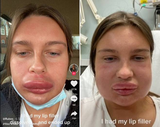 차안에선 윗 입술만 부어올랐지만 시간이 지남에 따라 병원에서는 양 뺨 등 얼굴 전체로 붓기가 확산했다. [틱톡 캡처]