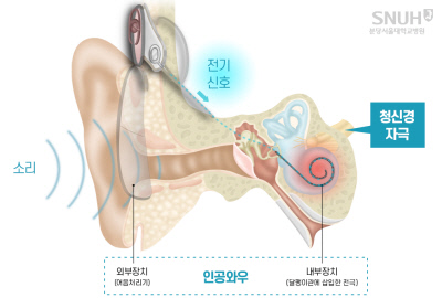 인공와우로 소리를 듣는 경로