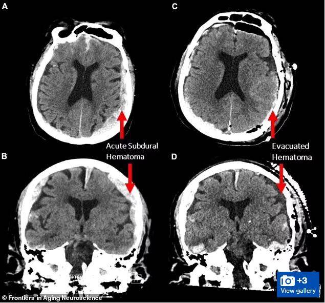 [서울=뉴시스]죽기 직전 지난 삶의 중요한 순간들이 주마등처럼 머리 속을 스쳐 지나간다는 말이 사실일 수 있음을 시사하는 과학적 증거가 우연히 포착됐다고 BBC가 23일(현지시간) 보도했다. 한 과학자 팀이 뇌전증(간질)에 걸린 87세 환자의 뇌파를 측정하던 도중 이 환자가 예상치 못하게 심장마비를 일으켜 사망하면서 그의 뇌파가 약 30초 가량 꿈을 꾸거나 기억을 떠올리는 것과 같은 패턴을 따른다는 사실이 밝혀졌다. <사진출처 : 데일리 메일> 2022.2.24