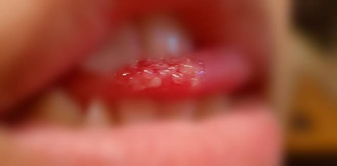 락스가 닿은 혀에 설유두가 올라왔다고 주장하는 사진. (온라인 커뮤니티 갈무리) © 뉴스1