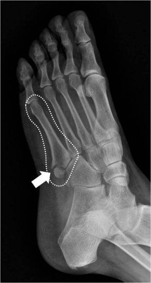 중족골 골절 [사진=한림대강남성심병원 제공]
