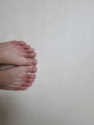 코로나19 후유증으로 인해, 따뜻한 물로 샤워하고 섭씨 26도로 맞춰진 따뜻한 방에서도 발 쪽만 차가워져 빨갛게 변한 강아무개씨의 발. 본인 제공