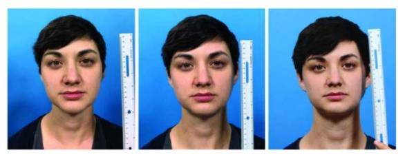 셀카와 DSLR로 찍은 얼굴 사진 비교 미국 텍사스대학교 사우스웨스턴 메디컬 센터 소속 연구진이 이끄는 연구에 참여한 사람들이 촬영한 셀카 사진과 DSLR 카메라로 찍은 얼굴 사진. 12인치 거리에서 찍은 셀카(왼쪽), 18인치 거리에서 찍은 셀카(가운데)는 DSLR을 사용해 찍은 사진보다 코가 더 크고 길게 보이는 경향이 뚜렷하다. CREDIT Plastic and Reconstructive Surgery