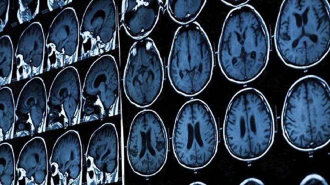 뇌 MRI 사진. 전 세계에서 10만명 이상의 뇌를 찍은 MRI 사진 12만여장으로 세계 최고 수준의 뇌 성장도표가 완성됐다./영 카디프대