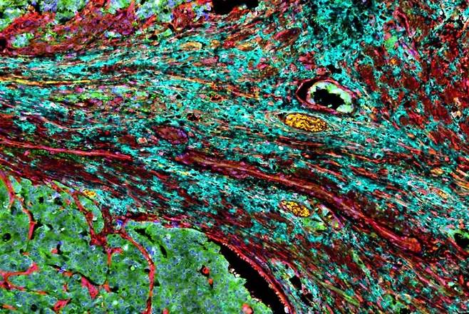 전립선암 종양을 싸고 있는 '암 관련 섬유아세포' [미국 웨일 코넬 의대 Moscat/Diaz-Meco lab.재판매 및 DB 금지]