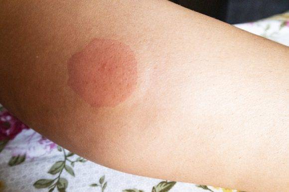 모기의 타액에 있는 단백질 성분에 우리 몸이 과민하게 대응하면서 나타나는 현상이다. [사진=게티이미지뱅크]