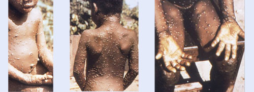 아프리카 콩고의 원숭이두창 환자. 미국 질병예방통제센터(CDC) 제공