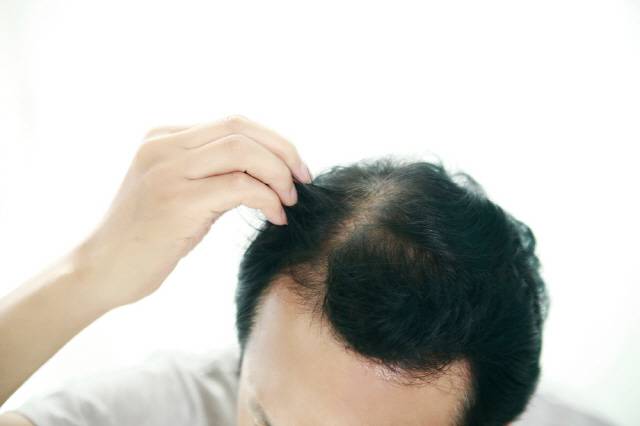 탈모는 천천히, 여러 단계를 거쳐 일어난다. 먼저 앞머리와 정수리 부위 머리카락이 점차 힘이 없고 가늘어지기 시작한다. /클립아트코리아 제공