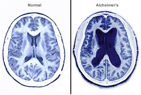 정상인 뇌(왼쪽)와 치매환자 뇌 모습.[사진 = 매경 DB]