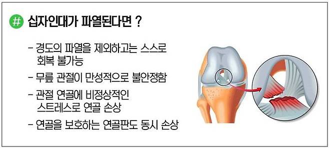 전방십자인대 파열. 연세건우병원 제공.