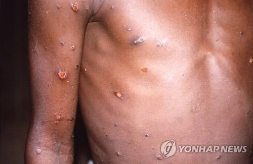 1996∼1997년 아프리카 콩고의 원숭이두창 환자  [로이터=연합뉴스 자료사진. 재판매 및 DB 금지]