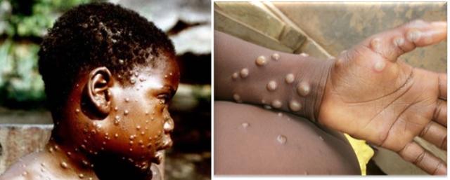 원숭이두창에 감염된 아이(왼쪽 사진)와 감염자의 손에 생긴 수포성 발진. WHO 홈페이지·나이지리아 질병통제센터