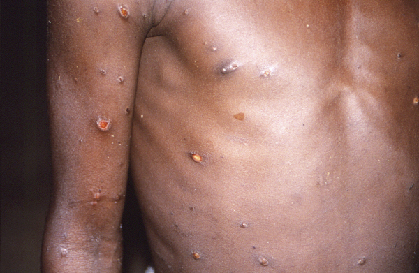 원숭이두창에 걸린 아프리카의 한 환자의 몸에 발진이 퍼져 있다. 사진은 미국 질병통제예방센터(CDC)가 제공한 것으로 지난 1997년 찍은 장면이다. AP 연합뉴스