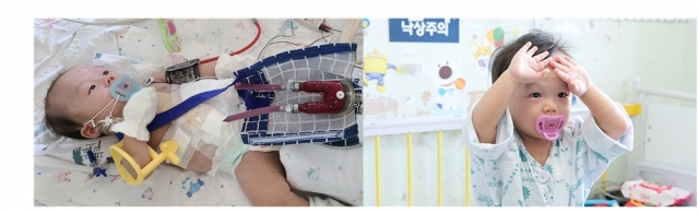 체외형 심실보조장치를 삽입한 권순후군(왼쪽)과 퇴원을 앞둔 모습. 서울대병원 제공