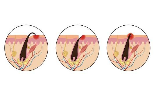 인그로운 헤어|출처: 게티이미지 뱅크