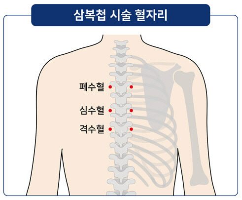 삼복첩 시술 혈자리, 6군데에 삼복첩을 붙여 시행한다.