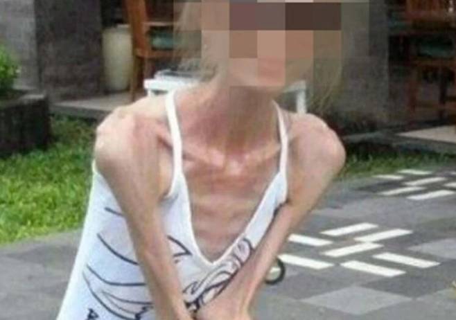 섭식장애를 겪어온 165㎝ 25㎏의 중국 여성이 최근 다발성 장기부전으로 중환자실에 입원했다고 SCMP가 지난 17일 보도했다.