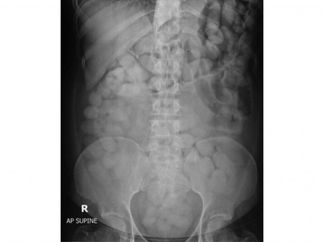 마약 밀수범의 X-ray 사진. 비닐로 돌돌 만 코카인 봉지의 형태가 보인다. 태국 세관 페이스북 캡처