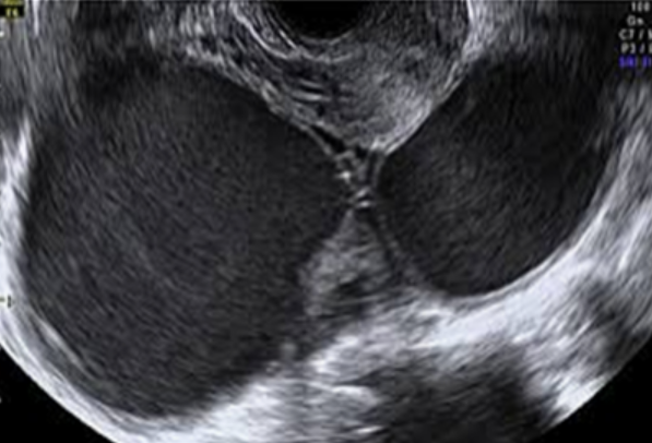 양측 난소의 자궁내막증 초음파.   국민건강보험공단