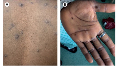 [사진] 원숭이두창 Skin and soft tissue manifestations of monkeypox *출처: The Lancet Infectious Disease. May 24, 2022. DOI: 10.1016/S1473-3099(22)00228-6