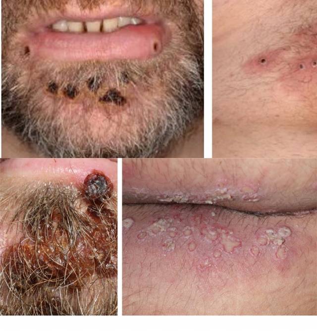 원숭이두창 환자에게 나타나는 발진 병변. 한국과학기자협회 제공