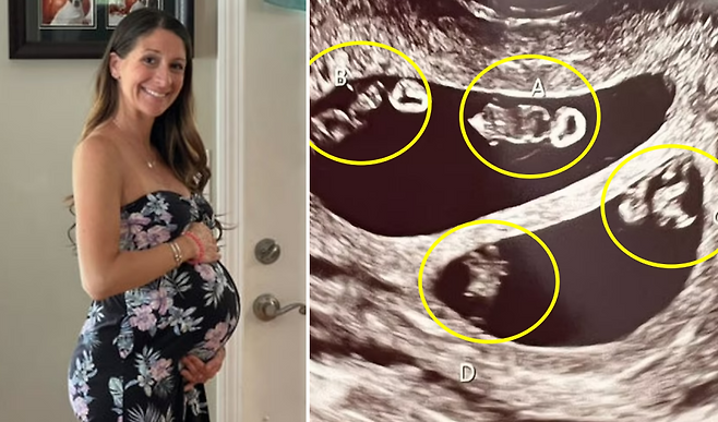 7000만 분의 1 확률로 두 쌍의 일란성 쌍둥이를 동시 임신한 여성(왼쪽)의 초음파 영상 캡쳐(오른쪽)