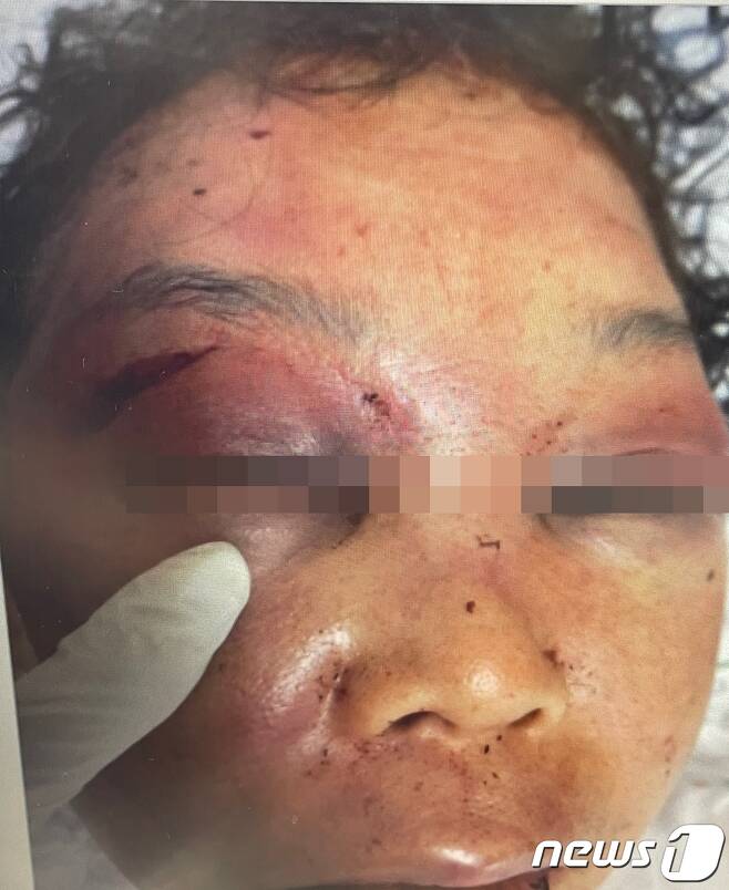 지난 19일 경남 통영의 한 노래방에서 50대 여주인 B씨가 폭행을 당해 병원에서 치료를 받는 모습.(피해자 가족측 제공)2022.7.1.© 뉴스1