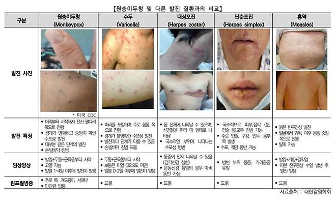 [서울=뉴시스]원숭이두창과 다른 발진 질환의 비교 및 특징. 사진 질병관리청 *재판매 및 DB 금지