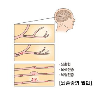 뇌졸중 [출처: 서울아산병원]