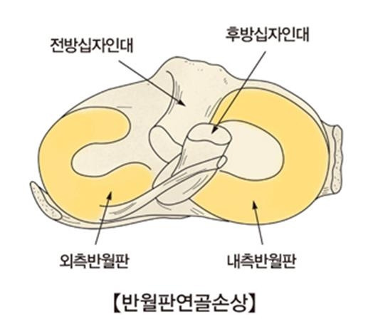 반월판 연골 손상 [출처: 서울아산병원]