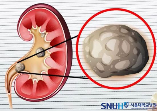 요로결석 이미지