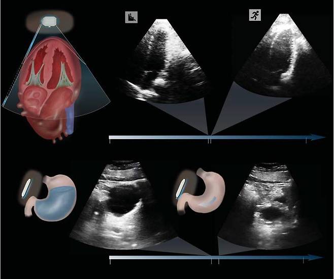 초음파 스티커를 피부에 붙이고 심장(위)과 위(아래)의 형태 변화를 확인한 영상들. 앉아 있을 때와 운동을 하고 난 뒤 심장 형태가 다른 것을 보여주며, 음료수가 찼다가 빠져나가며 위가 팽창, 수축하는 것도 알 수 있다./Science