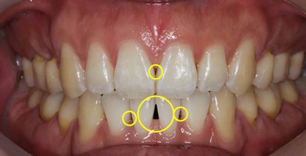 블랙트라이앵글이 생긴 치아/ 사과나무치과병원 제공