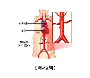 복대동맥 [출처: 서울아산병원]