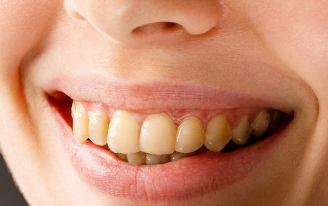 평소 즐겨먹는 식품으로 인해 치아가 누렇게 변색될 수 있다./사진=게티이미지뱅크