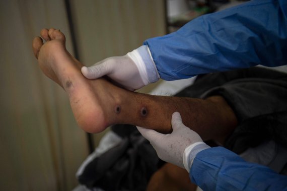 페루 리마의 원숭이두창 격리병동에서 한 의사가 원숭이두창 환자의 상처를 살펴보고 있다. /AFP 연합뉴스
