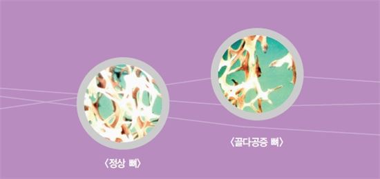 골다공증 관련 사진(출처: 질병관리본부)