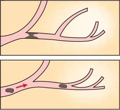 심부정맥 혈전 [출처: 서울아산병원]