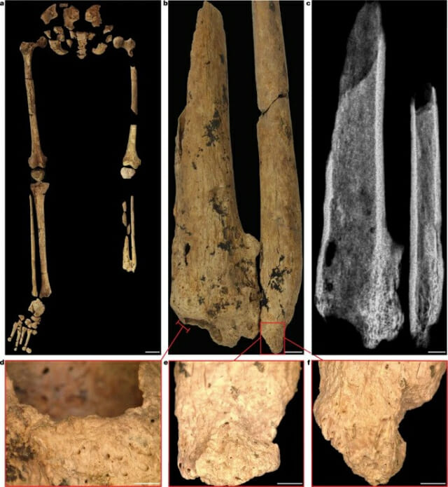 보르네오 섬에서 발견된 절단 수술 흔적이 있는 다리 뼈 (자료=그리피스대학)