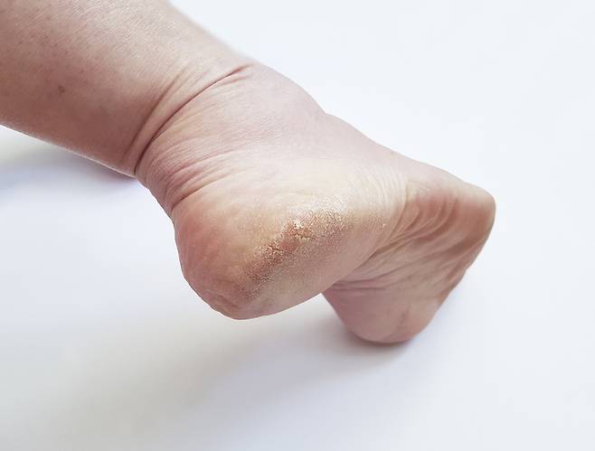 각화형 무좀은 단순 각질 증상만 발생할 수 있어 방치하기 쉽다./사진=게티이미지뱅크