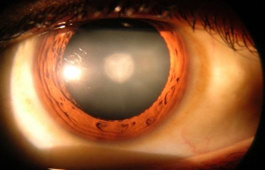 백내장 중기ㅣ출처:비앤빛강남밝은세상안과