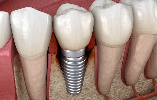 임플란트 주위염ㅣ출처: 게티이미지 뱅크