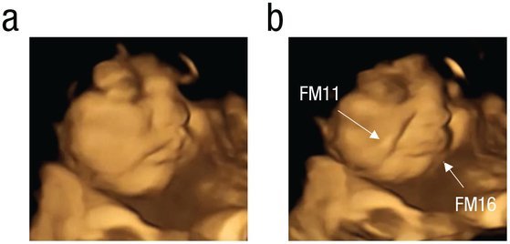 케일을 섭취한 임신부 집단의 태아들(b)에게서 아무것도 섭취하지 않은 임신부 집단의 태아들(a)보다 내려간 입꼬리가 관찰됐다. 사이컬러지컬 사이언스 저널 캡처
