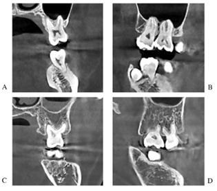 치아 뿌리가 상악동 동굴 내부로 들어간 CBCT 사진 (A,B), 상악동 동굴 내부로 들어가지 않은 CBCT 사진 (C,D) A,C는 관상면(신체를 앞뒤로 나누는 가상의 면) B,D는 시상면(신체를 좌우로 나누는 가상의 면). 가톨릭대 서울성모병원 제공