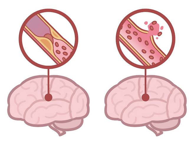 뇌졸중(뇌경색(좌), 뇌출혈(우)) [사진 출처 = 게티이미지뱅크]