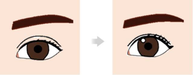 안검하수가 아닌 눈도 수술로 또렷하게 만드는 미용적 효과를 볼 수는 있다.